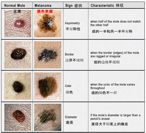 胸上长痣|痣也可能会癌变！长在 3 个地方要注意